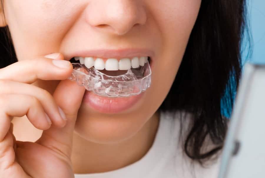 invisalign treatment in Raleigh NC