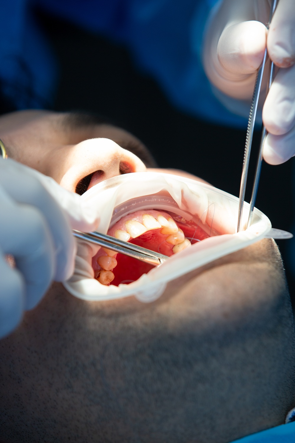 Same-Day Emergency Root Canals in Wilmington