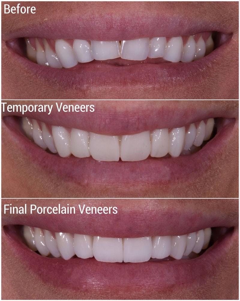 porcelain veneers in Siler City - O2 Dental Group - O2 Dental Group porcelain veneers in Siler City