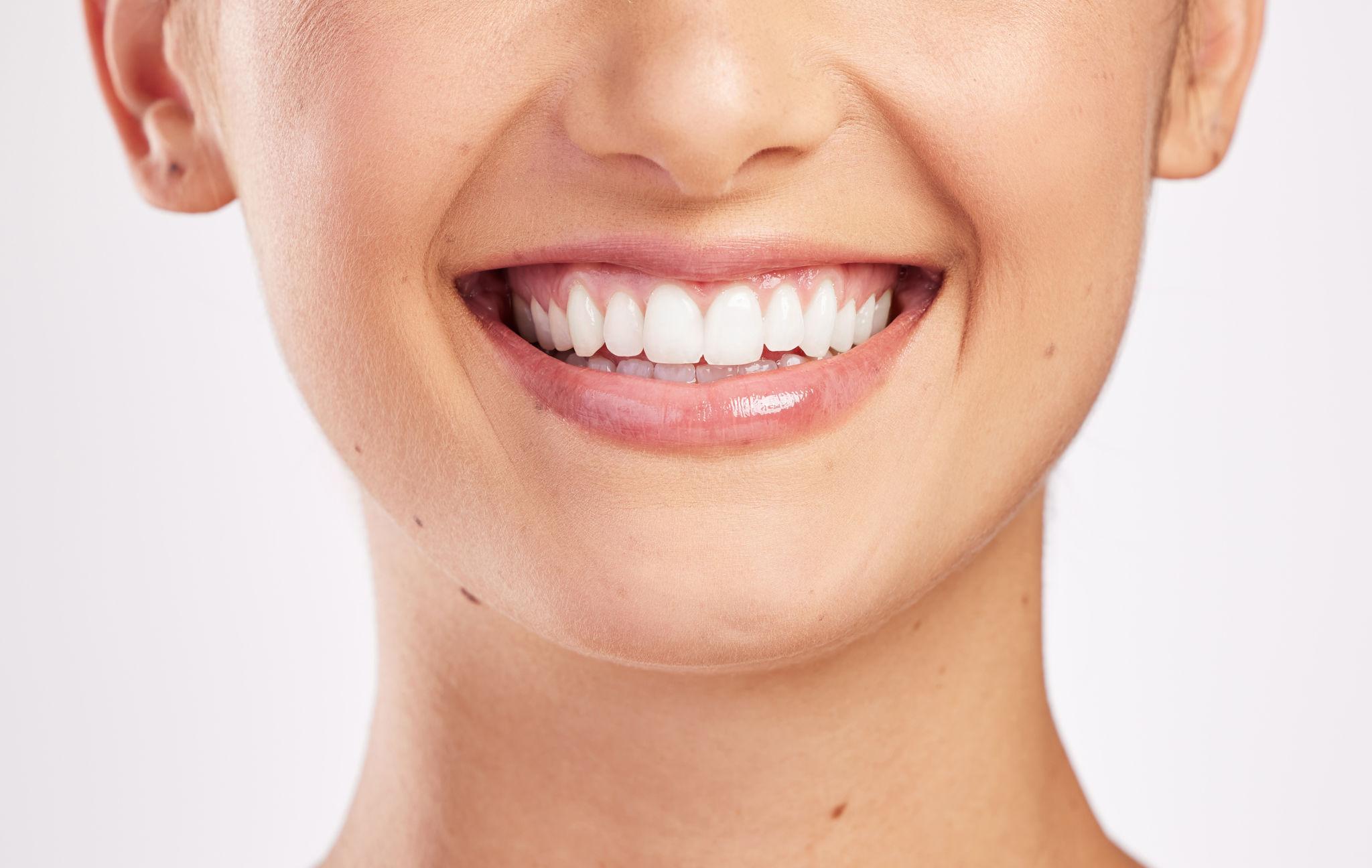 porcelain veneers in Wilmington NC - O2 Dental Group - O2 Dental Group porcelain veneers in Wilmington NC