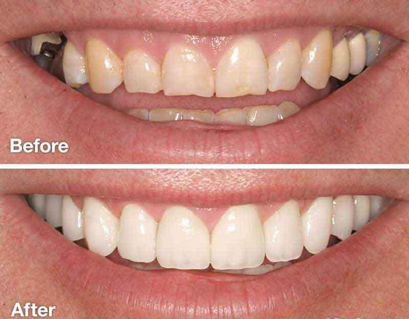 porcelain veneers treatment Siler City NC - O2 Dental Group - O2 Dental Group porcelain veneers treatment Siler City NC