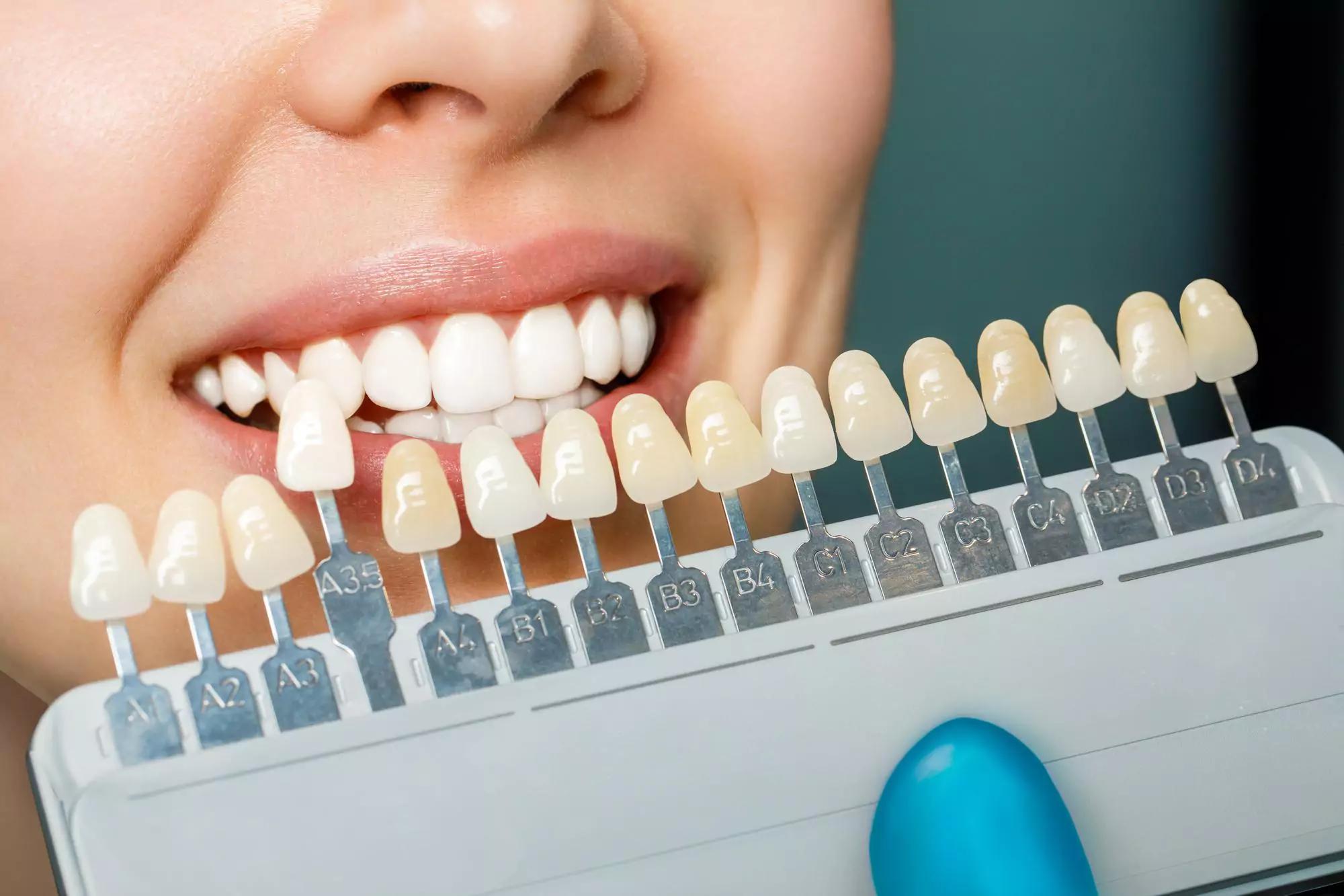 porcelain veneers treatment Southern Pines