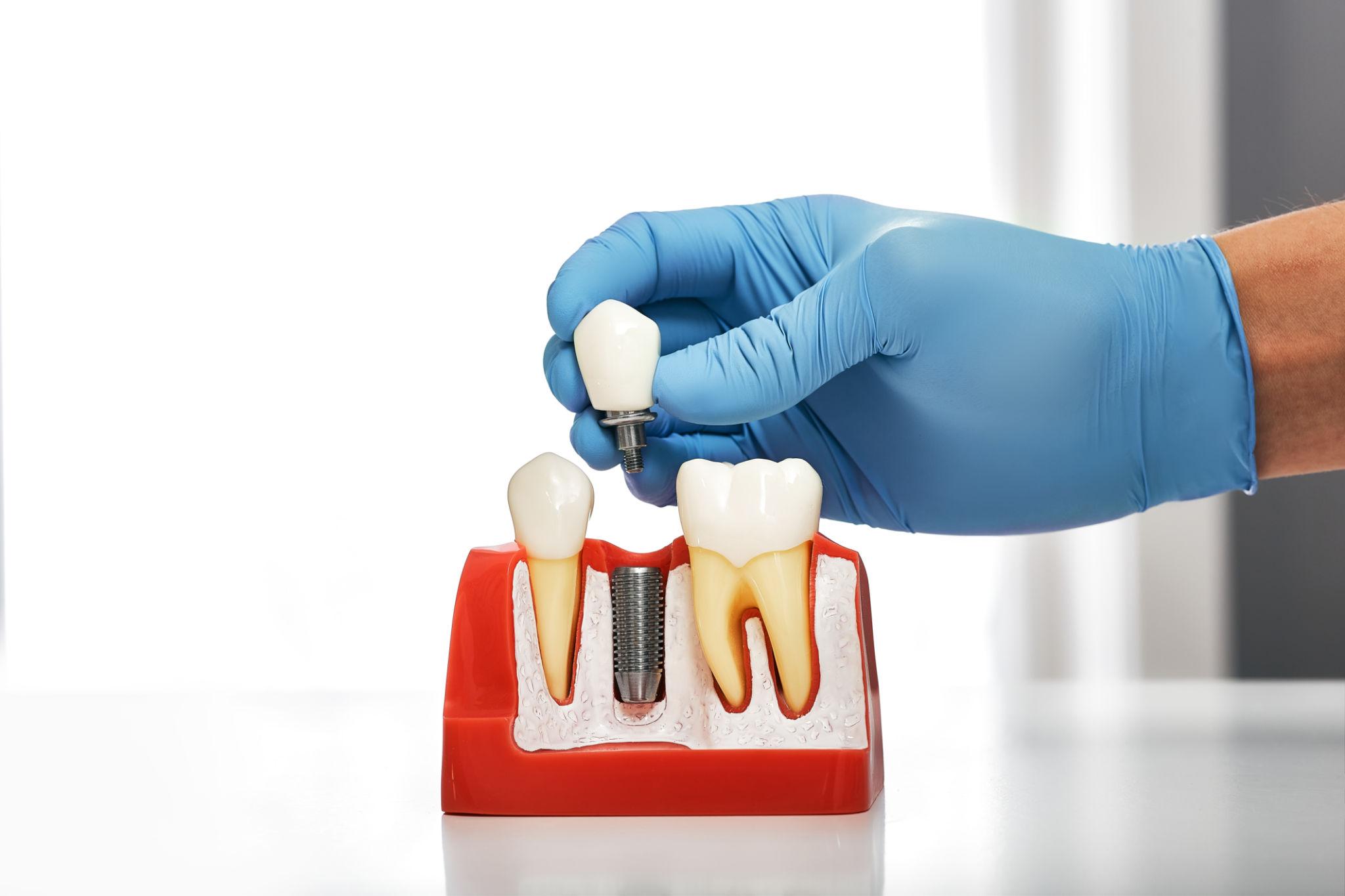 same day dental implants Wilmington NC