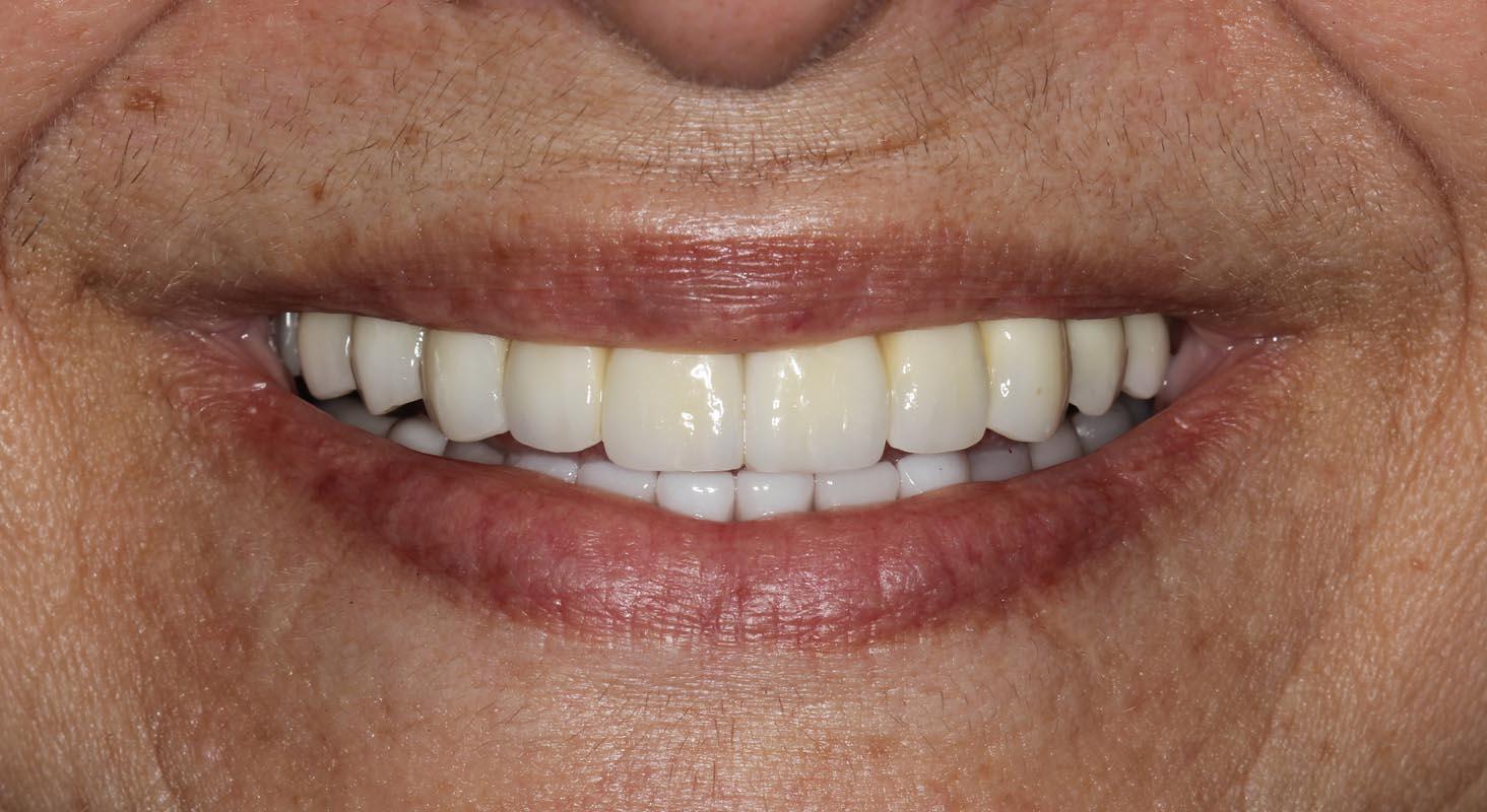 All-on-4 Full-Arch Implants Consultation in Durham NC