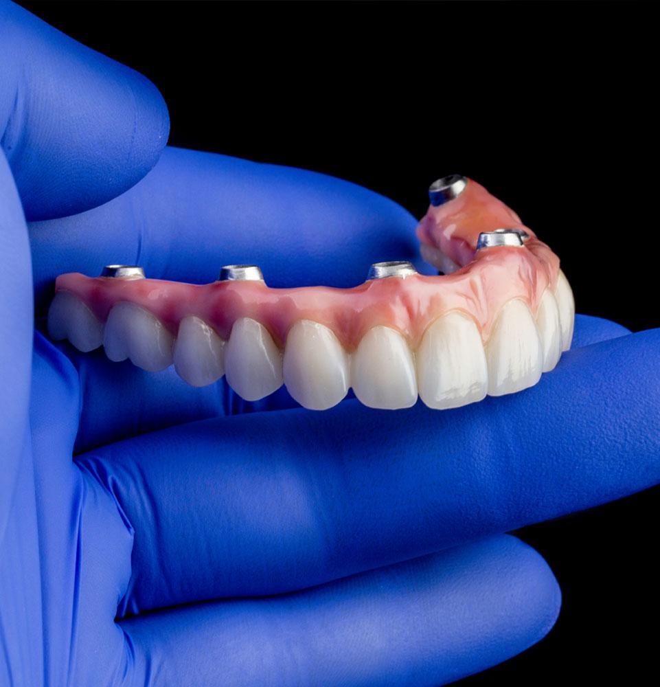 All-on-4 Full-Arch Implants Consultation in Durham