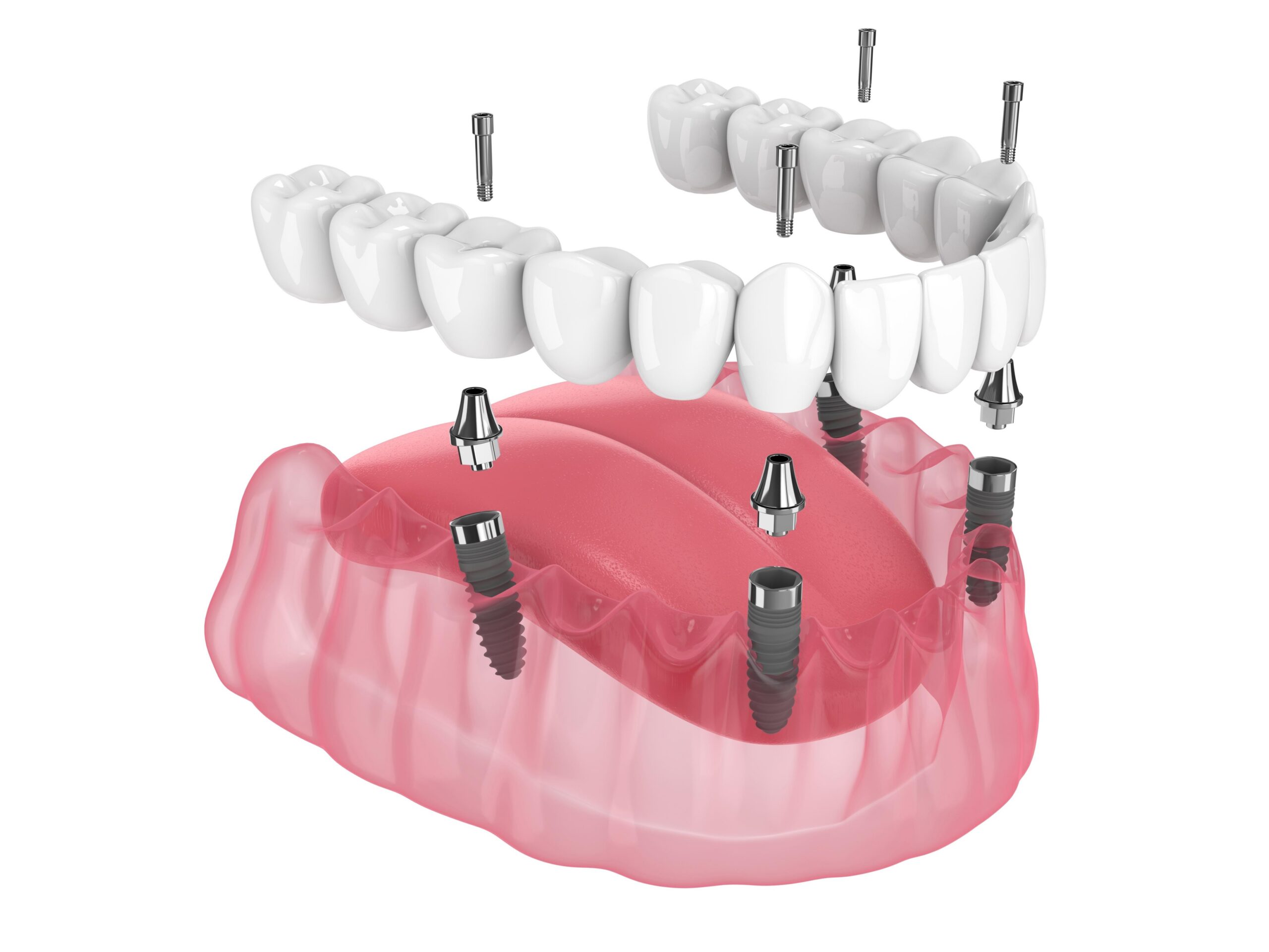 All-on-4 Full-Arch Implants Dentist in Durham NC​