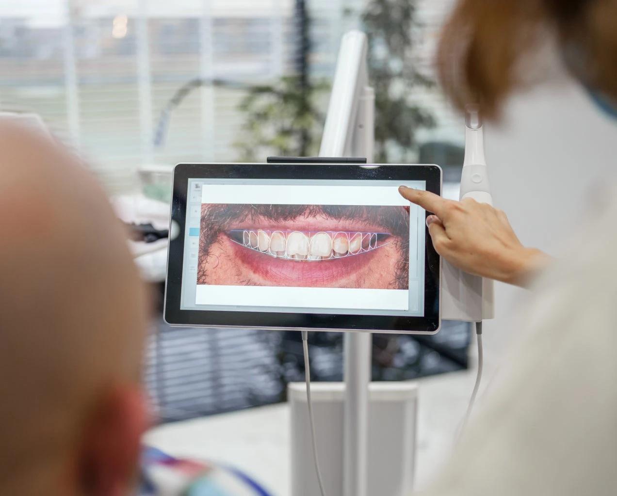 All-on-4 Full-Arch Implants Treatment in Raleigh NC