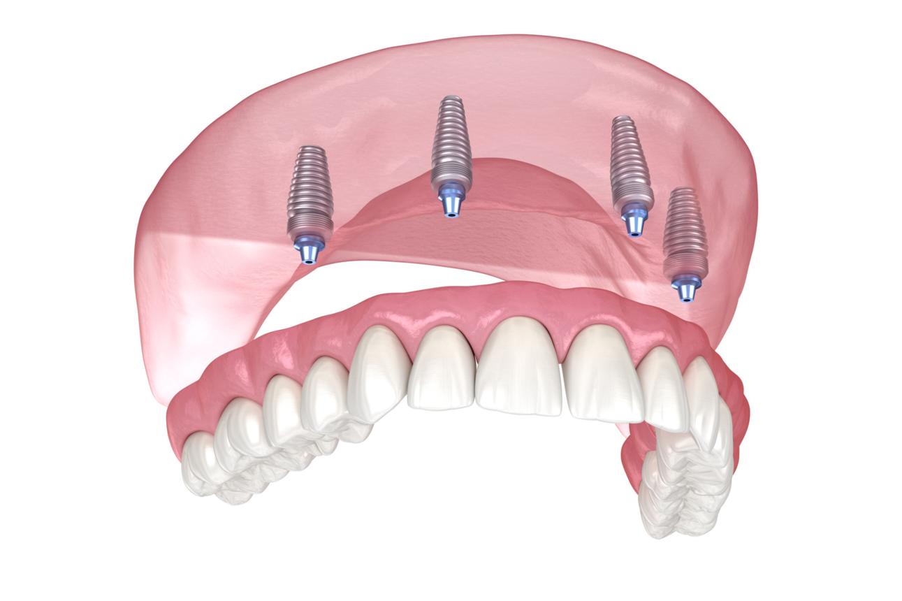 All-on-4 Full-Arch Implants in Durham