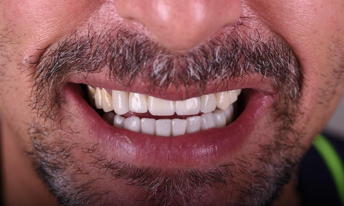Close-up of a man's mouth showing a broad smile with white, uniform teeth and a gray beard/mustache.