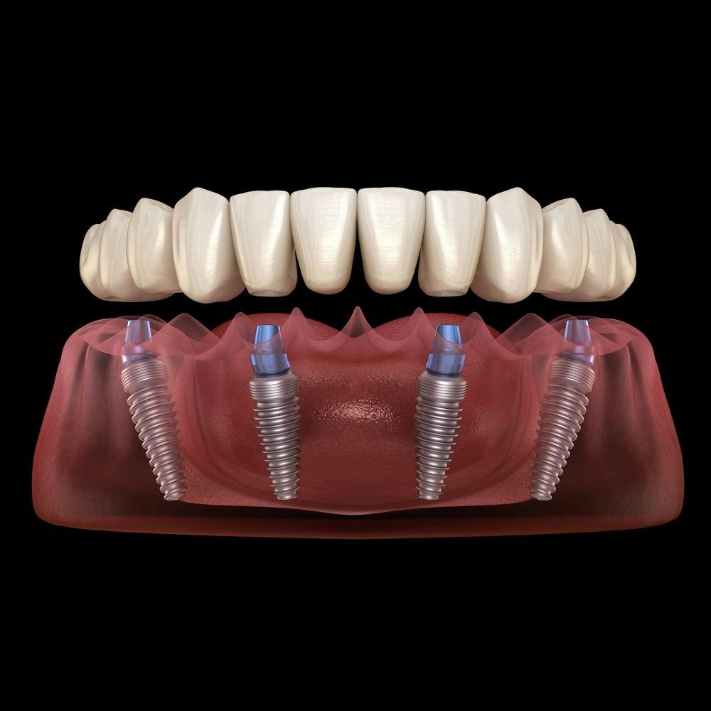 All-on-4 Full-Arch Implants in Fayetteville