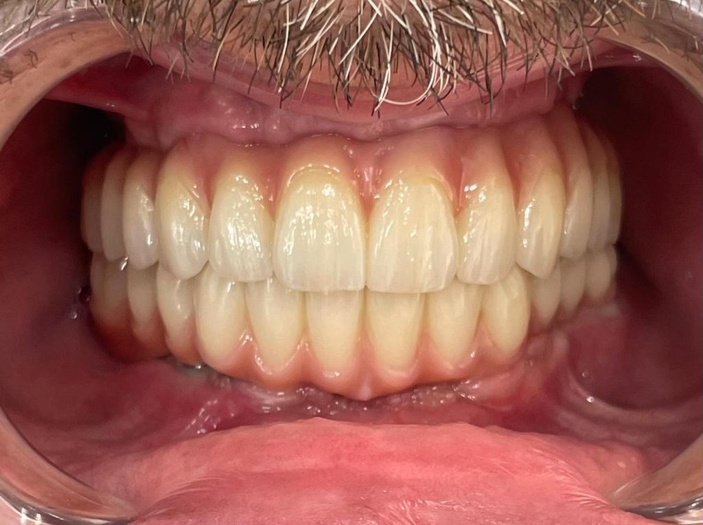 All-on-4 Full-Arch Implants in Fayetteville, NC​