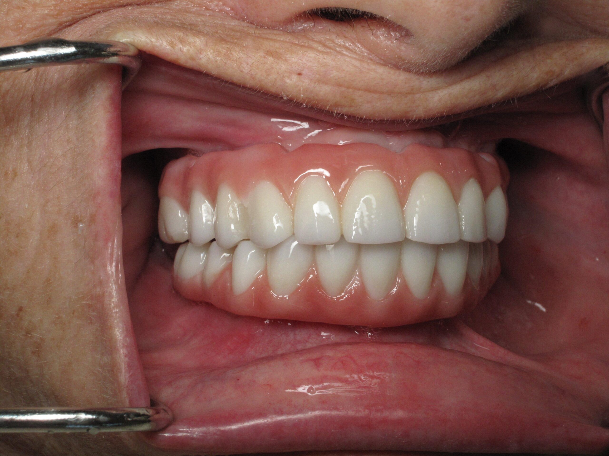 All-on-4 Full-Arch Implants in NC