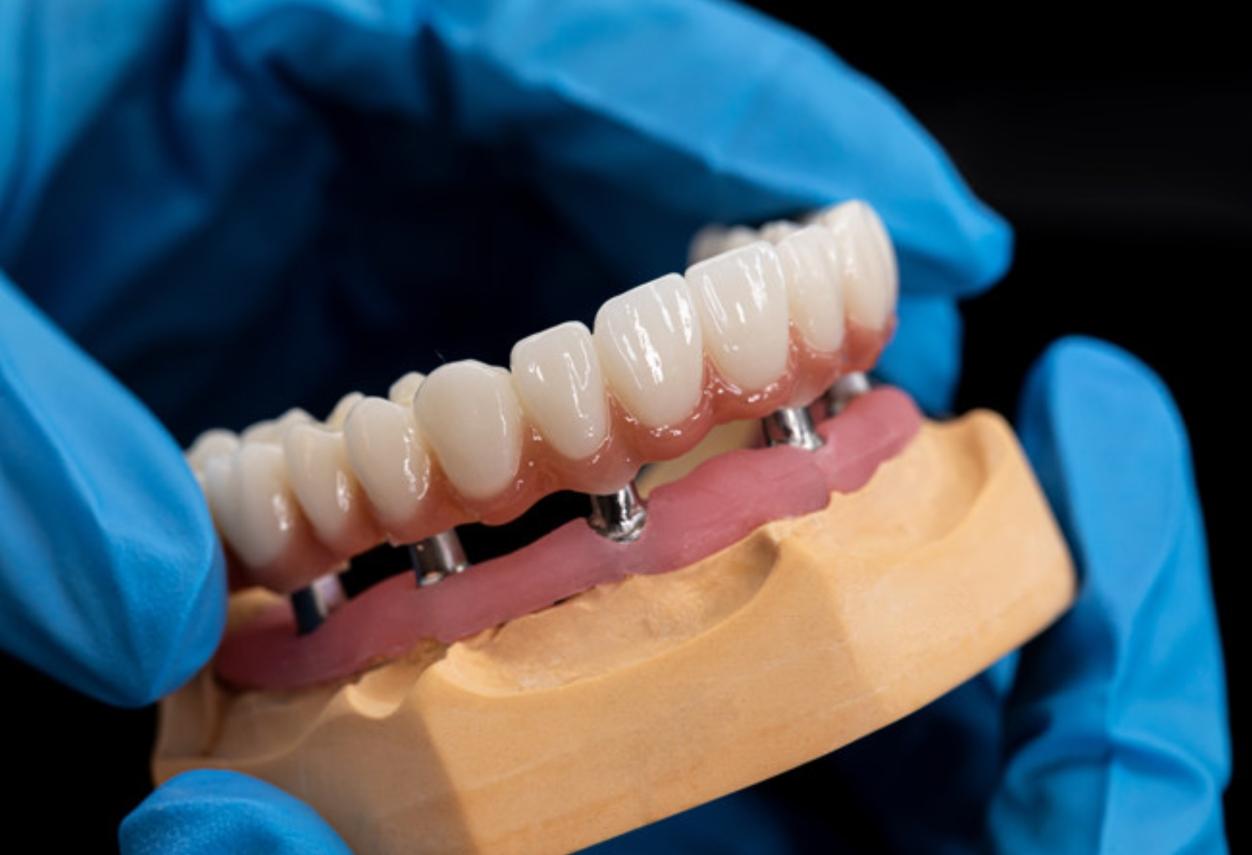 All-on-4 Full-Arch Implants in Raleigh NC-
