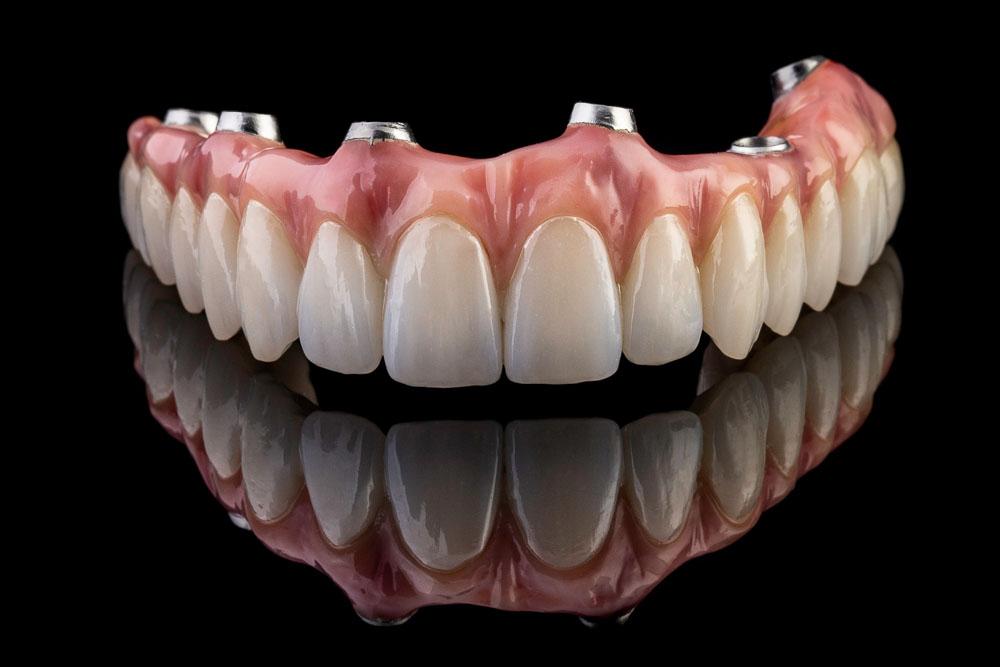 All-on-4 Full-Arch Implants in Siler City