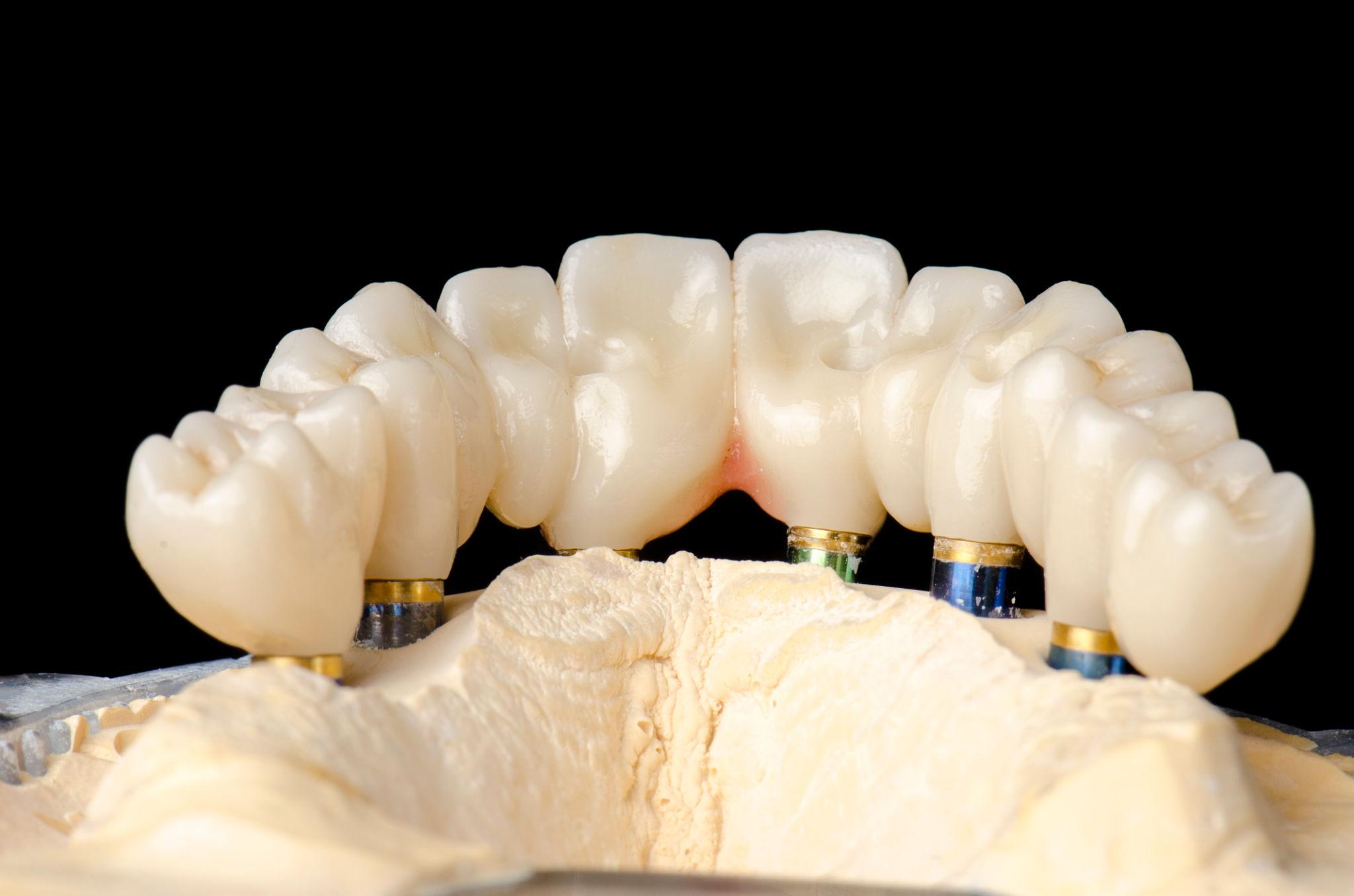 All-on-4 Full-Arch Implants Consultation in Southern Pines NC