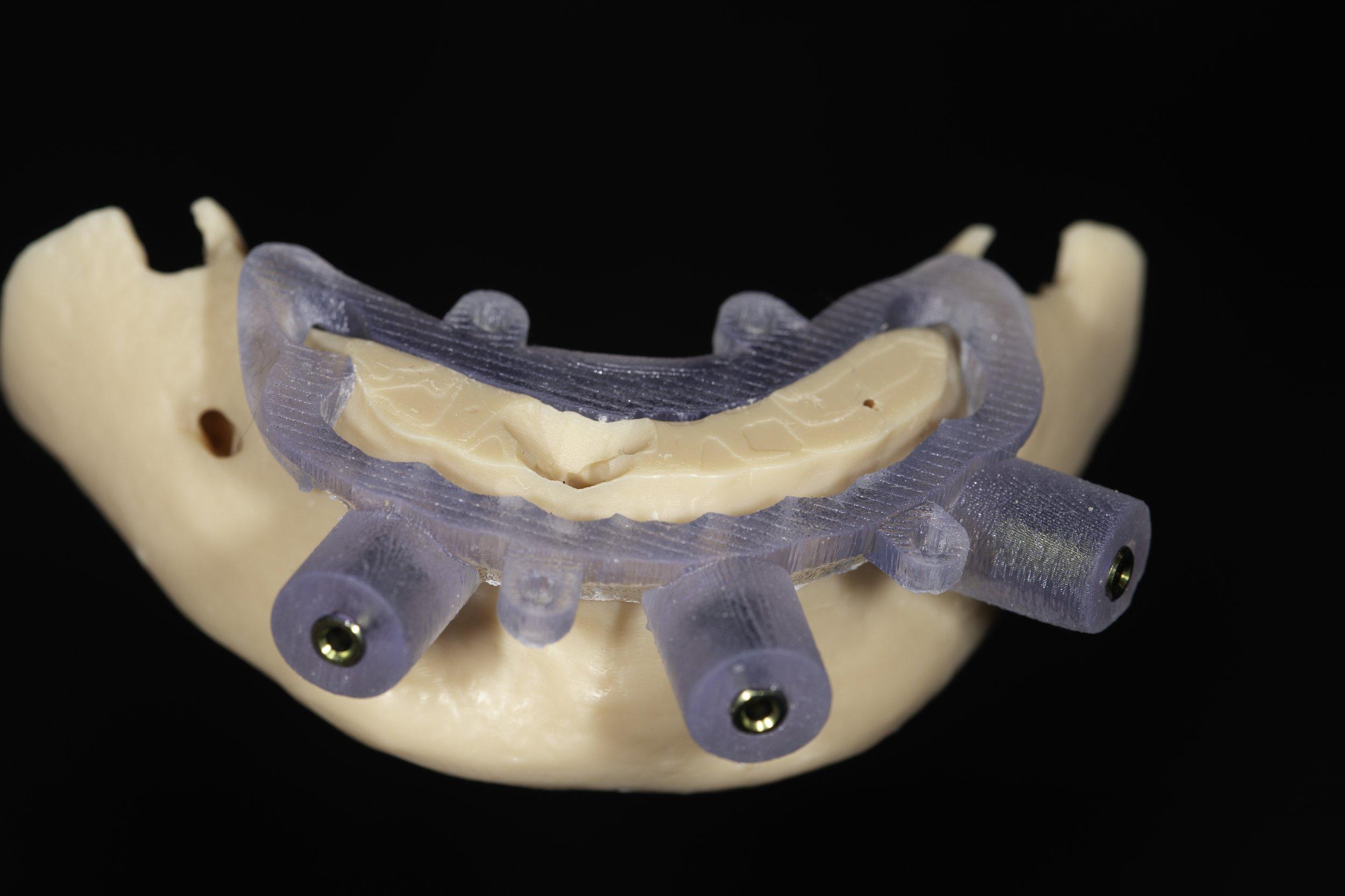 All-on-4 Full-Arch Implants Dentist in Southern Pines