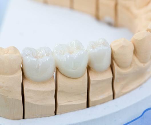Dental plaster model showing three front teeth with white ceramic crowns on a dental cast