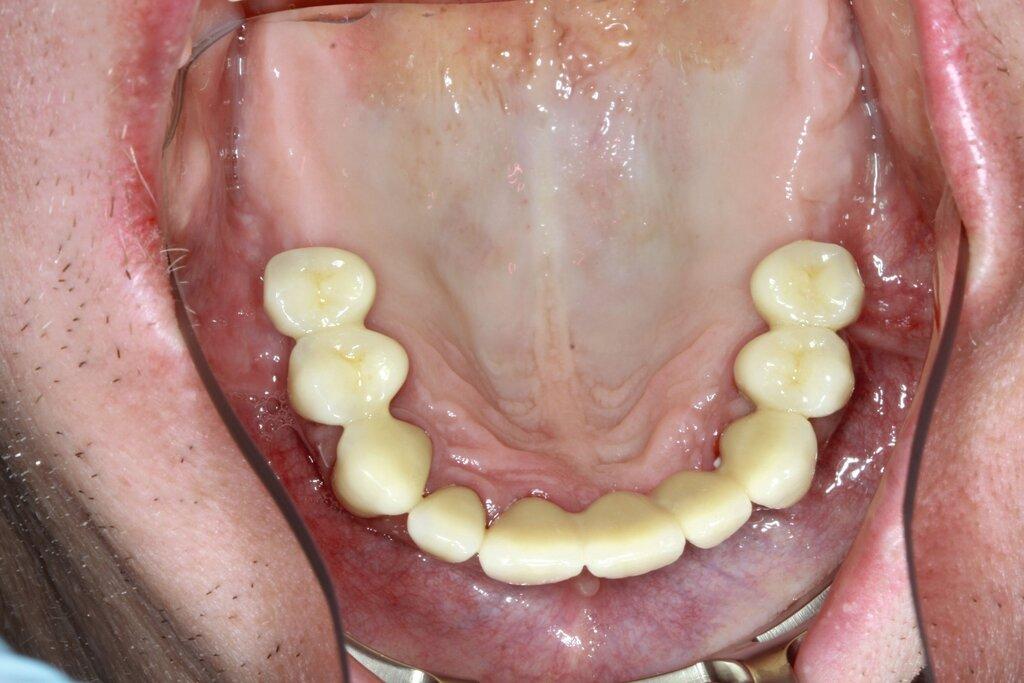Dental Bridges in Durham NC