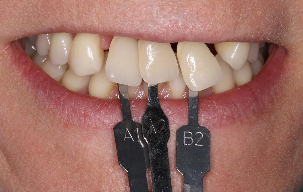 Dental Bridges in Durham