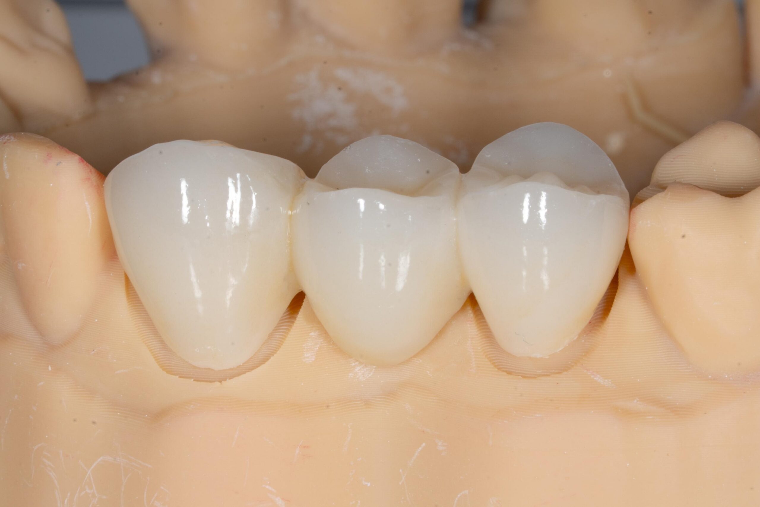 Dental Bridges in Fayetteville NC