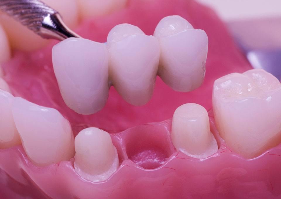 Dental Bridges in Fayetteville