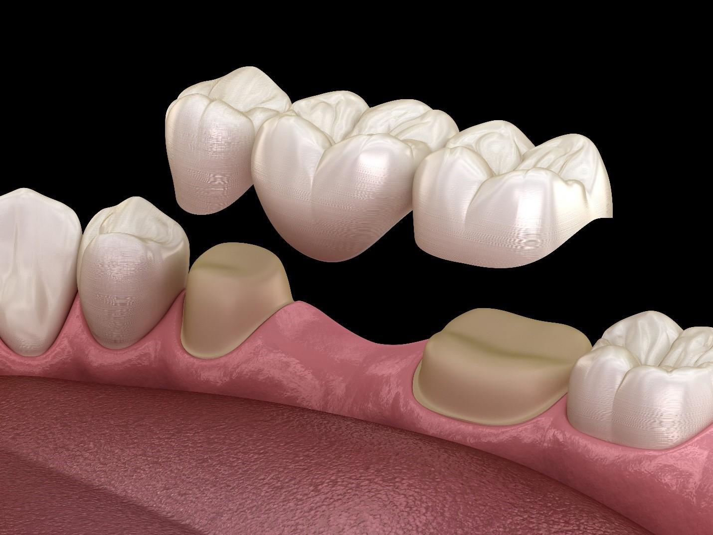 Dental Bridges in Siler City NC