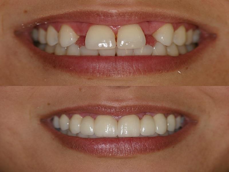 Dental Bridges in Siler City