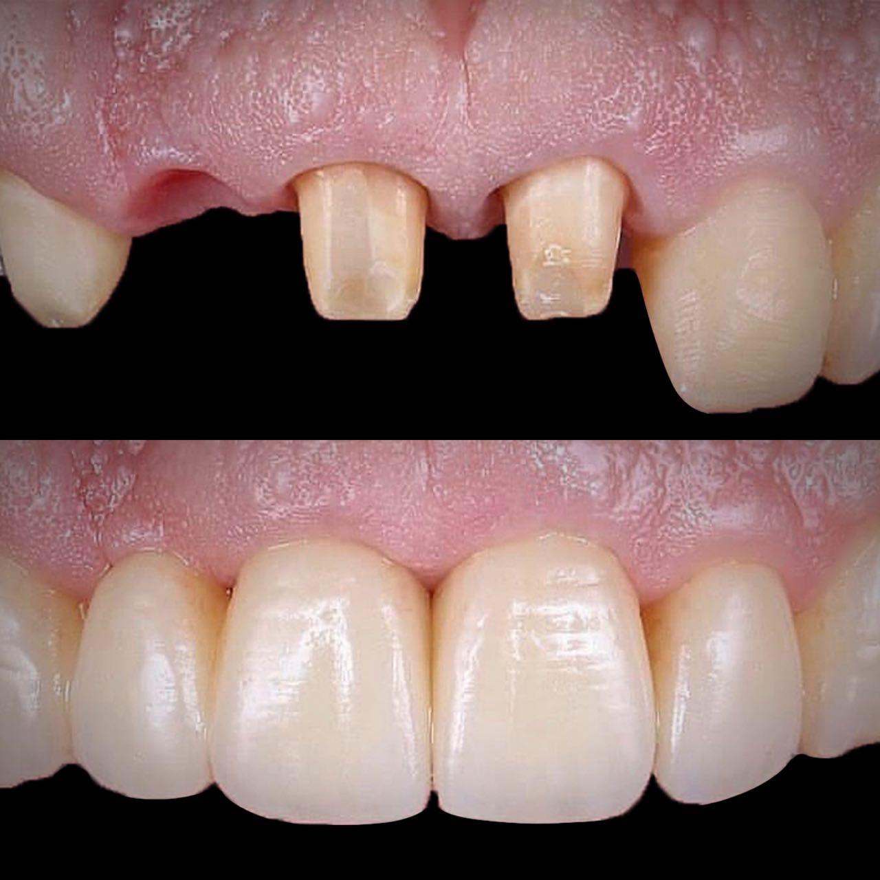 Dental Bridges in Southern Pines NC