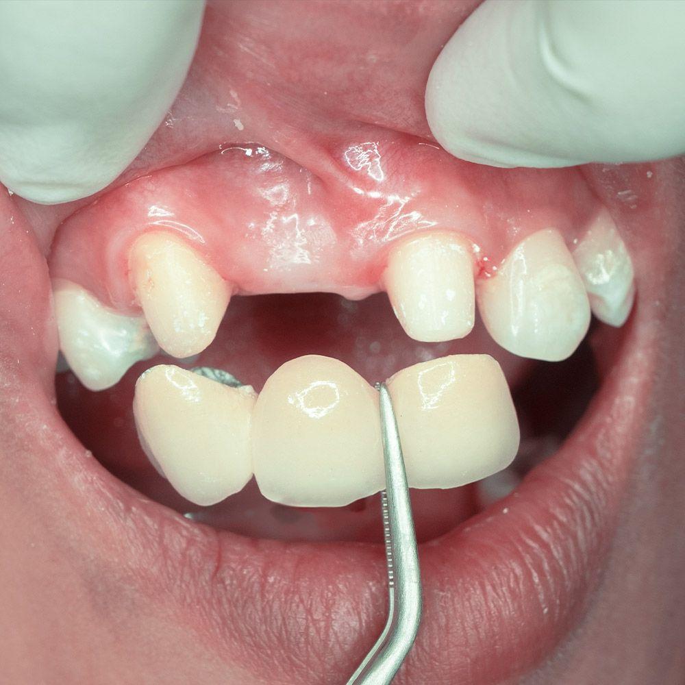 Dental Bridges in Southern Pines