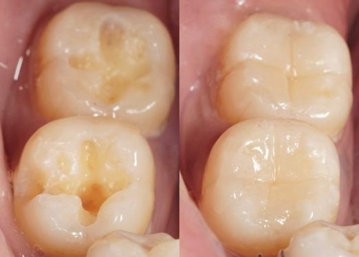 Dental Fillings Consultation in Fayetteville