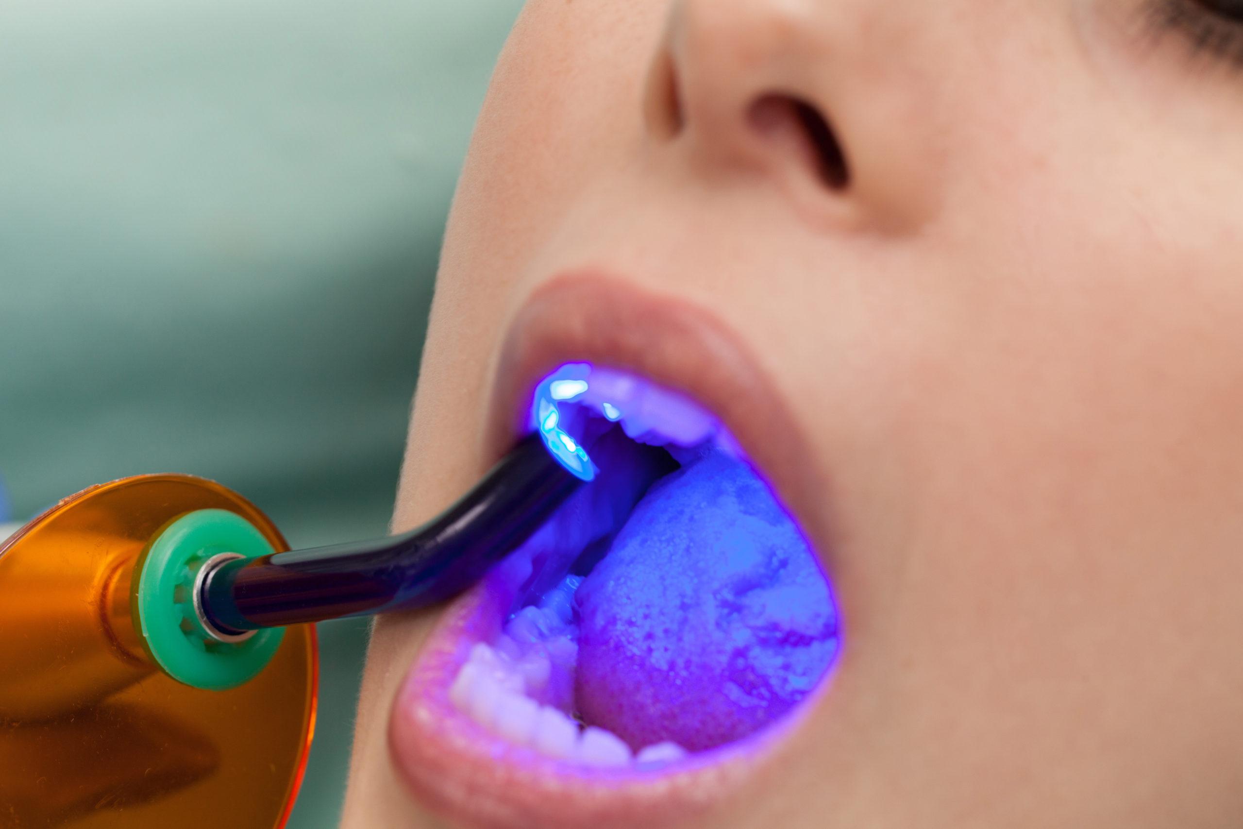 Dental Fillings Consultation in North Carolina
