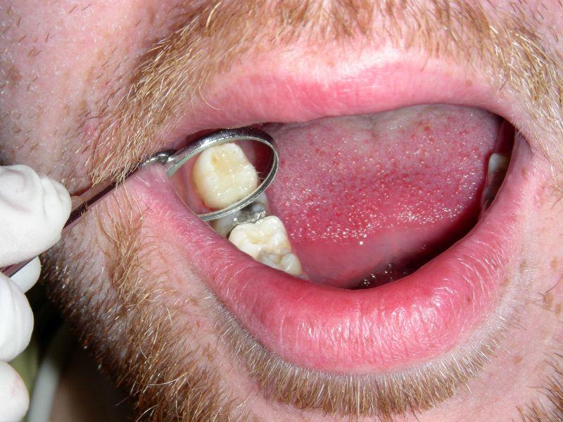 Dental Fillings Consultation in Raleigh NC