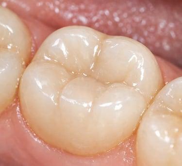 Dental Fillings Consultation in Siler City NC