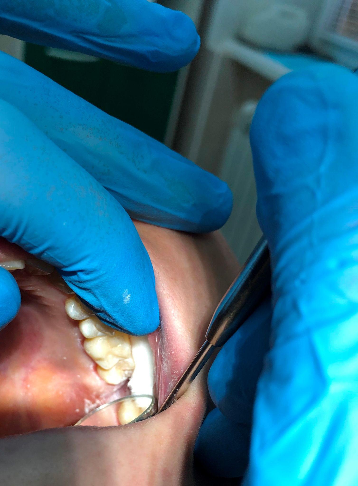 Dental Fillings Consultation in Southern Pines NC