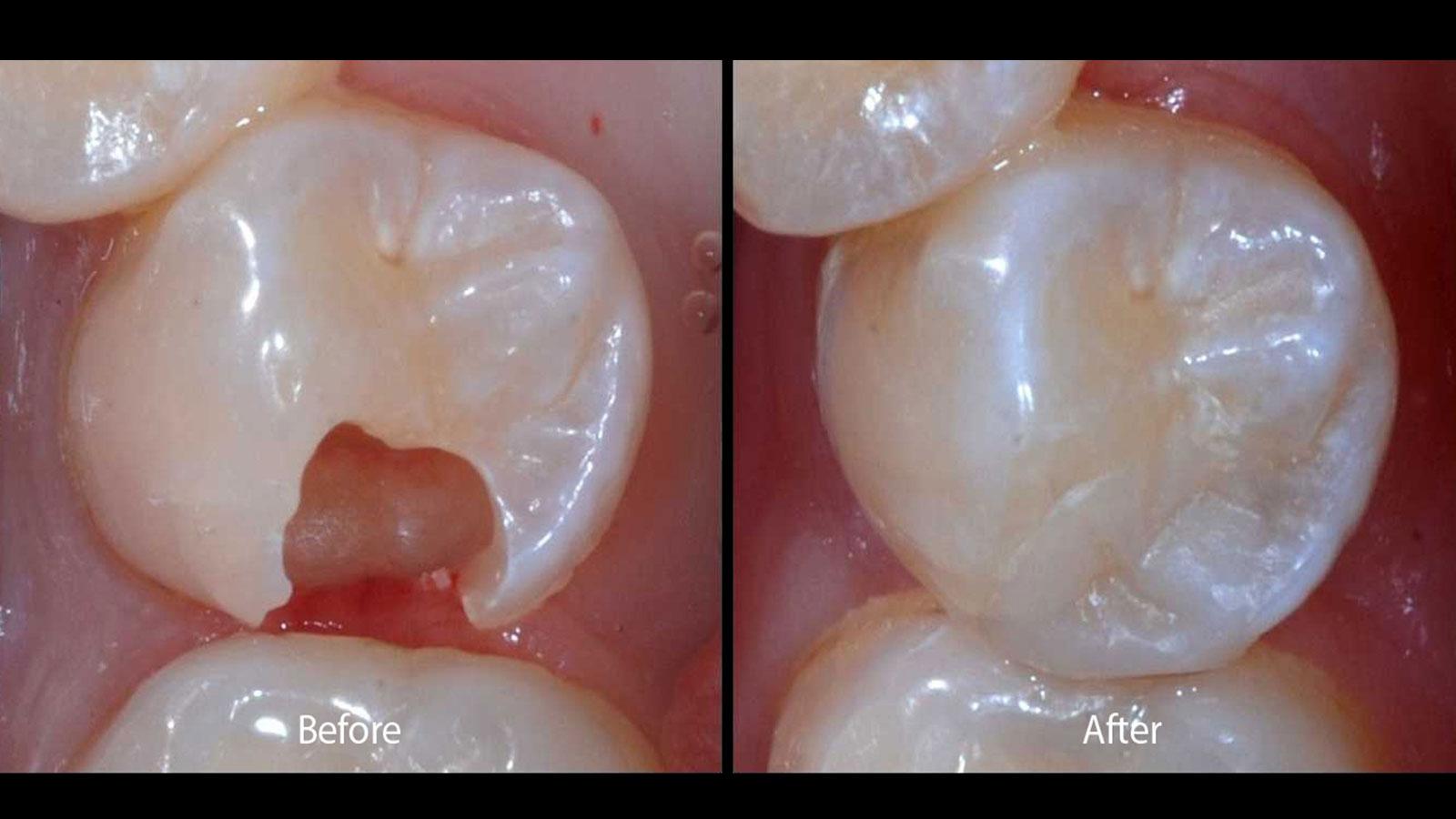 Dental Fillings Dentist in Fayetteville NC