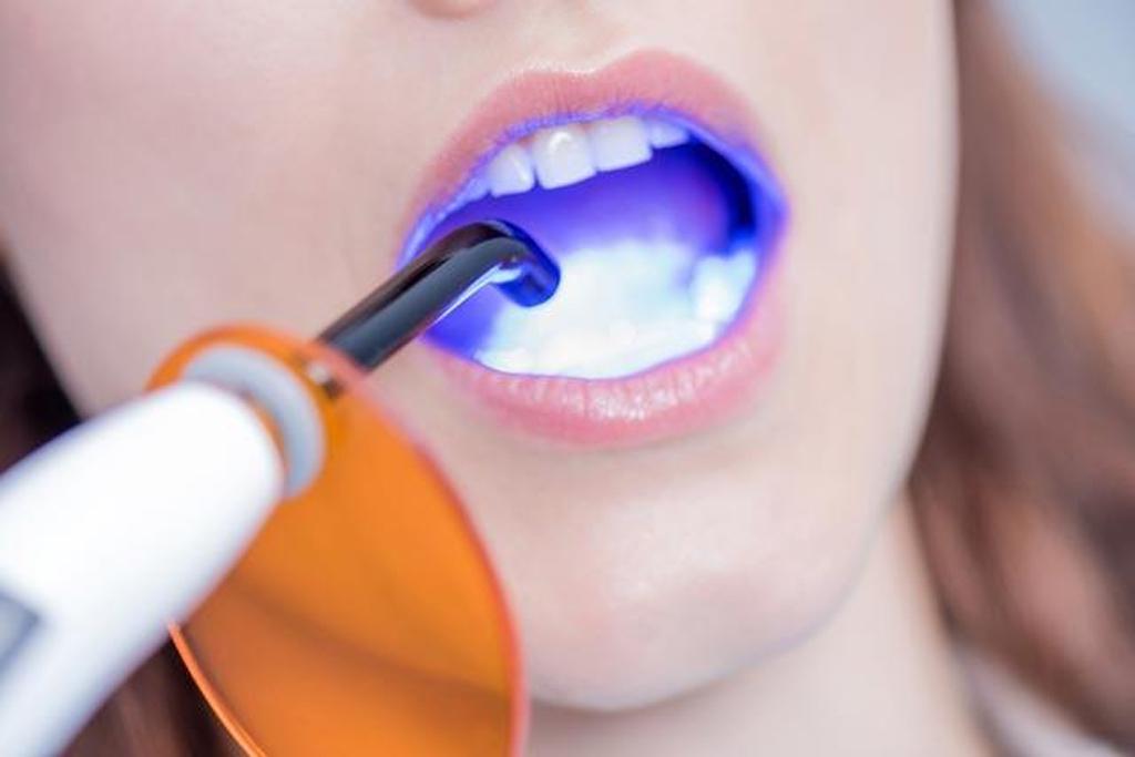 Dental Fillings Dentist in North Carolina