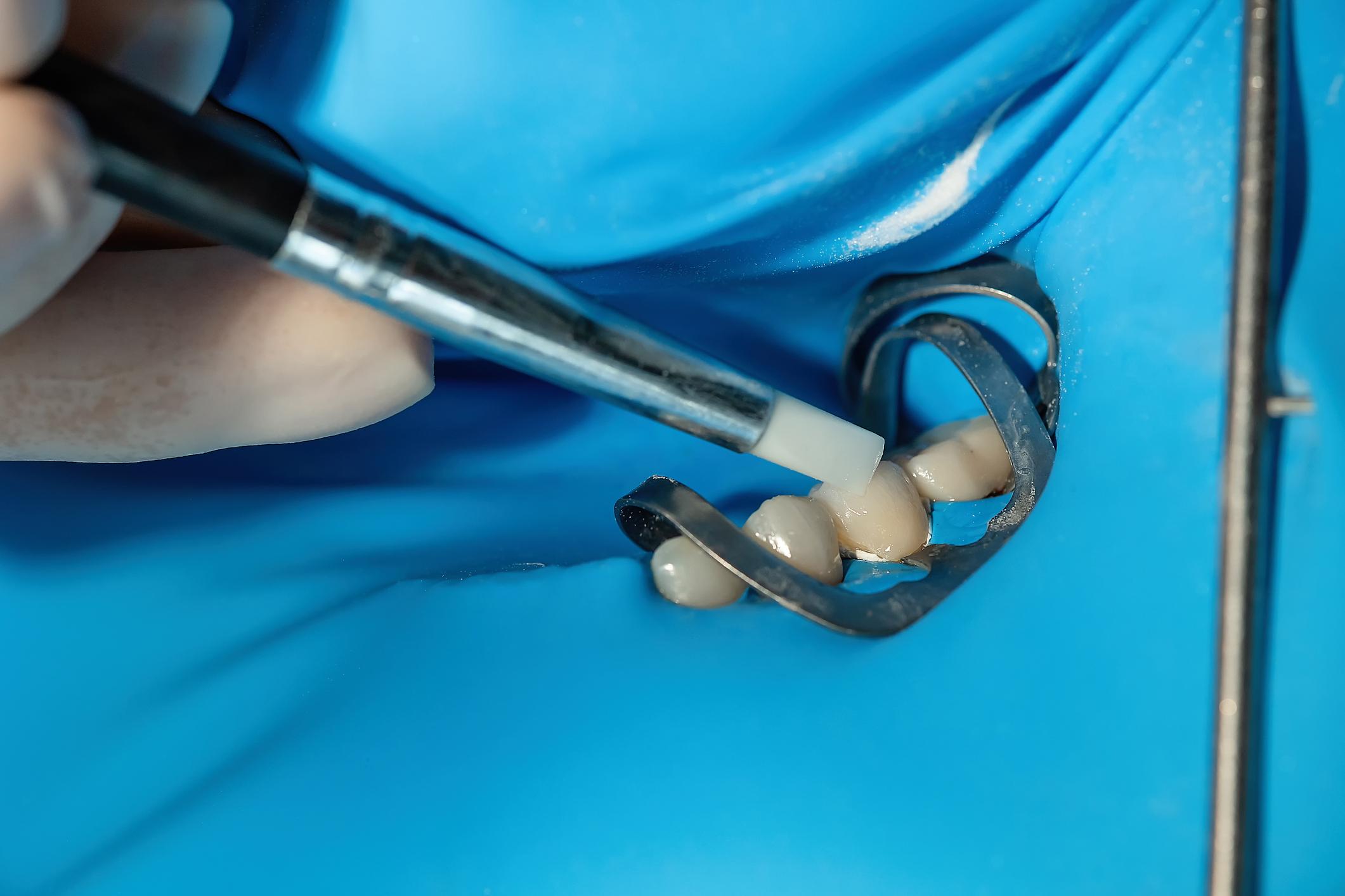 Dental Fillings Dentist in Siler City NC