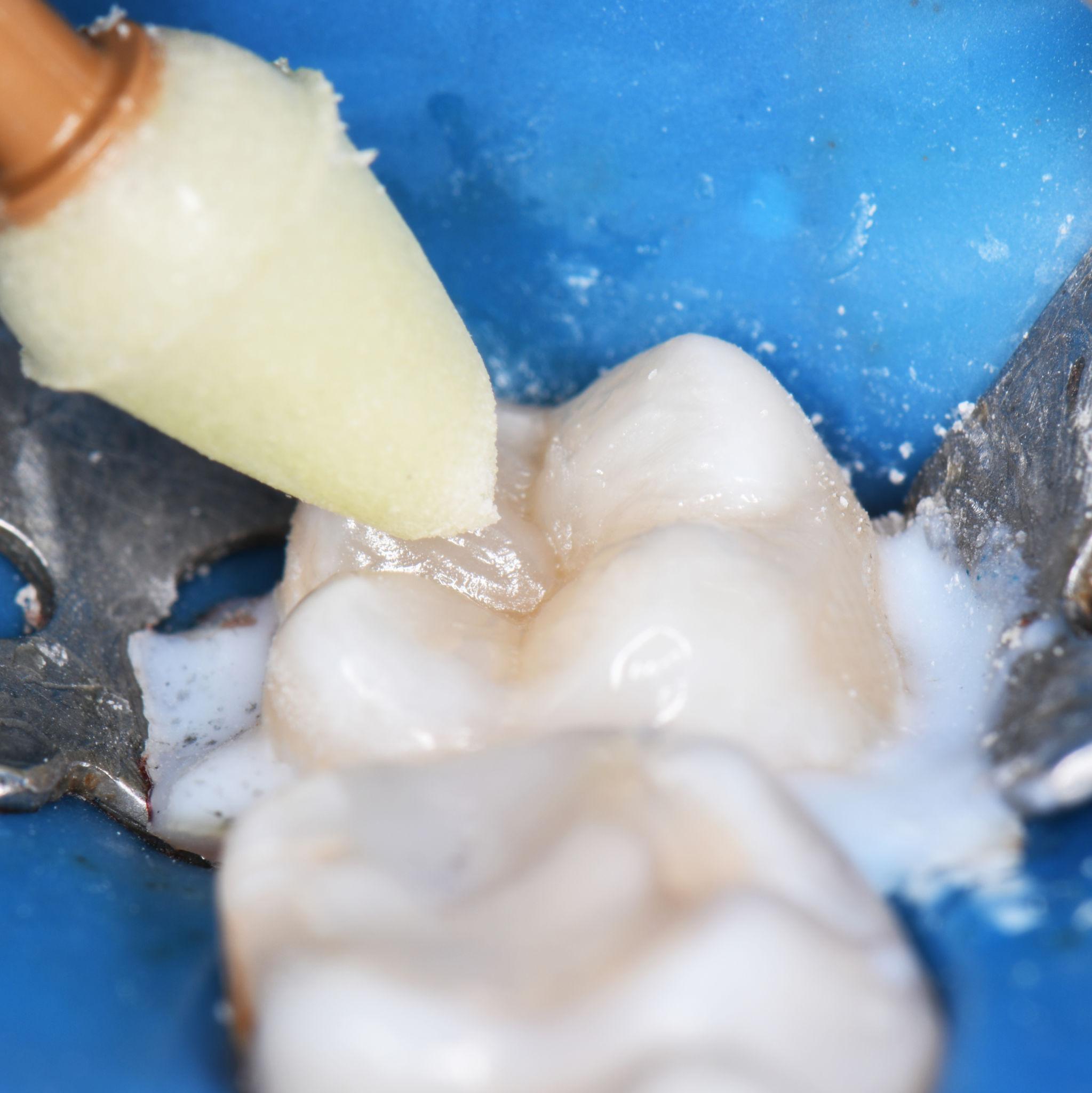 Dental Fillings Dentist in Southern Pines NC