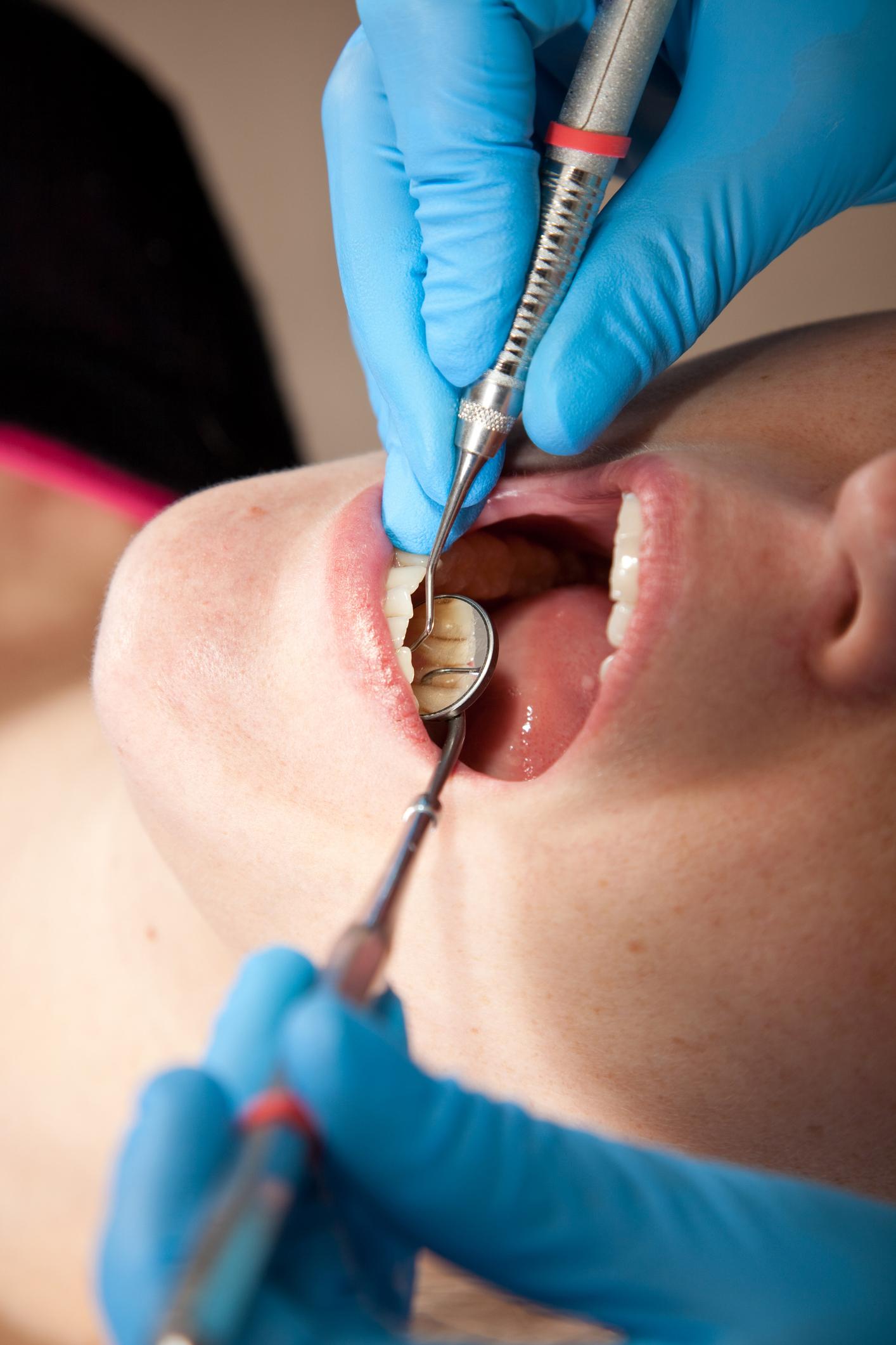 Dental Fillings in Durham NC