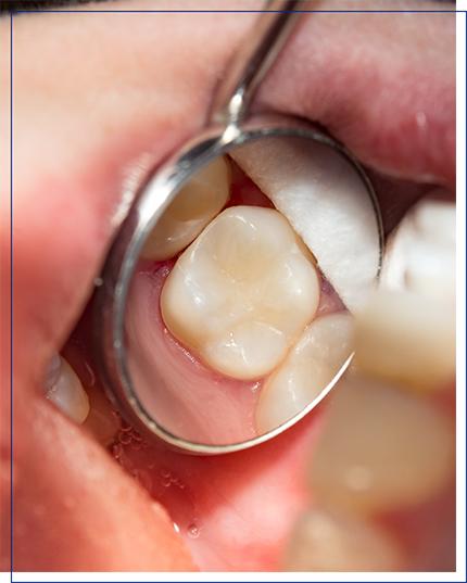 Dental Fillings in Fayetteville NC
