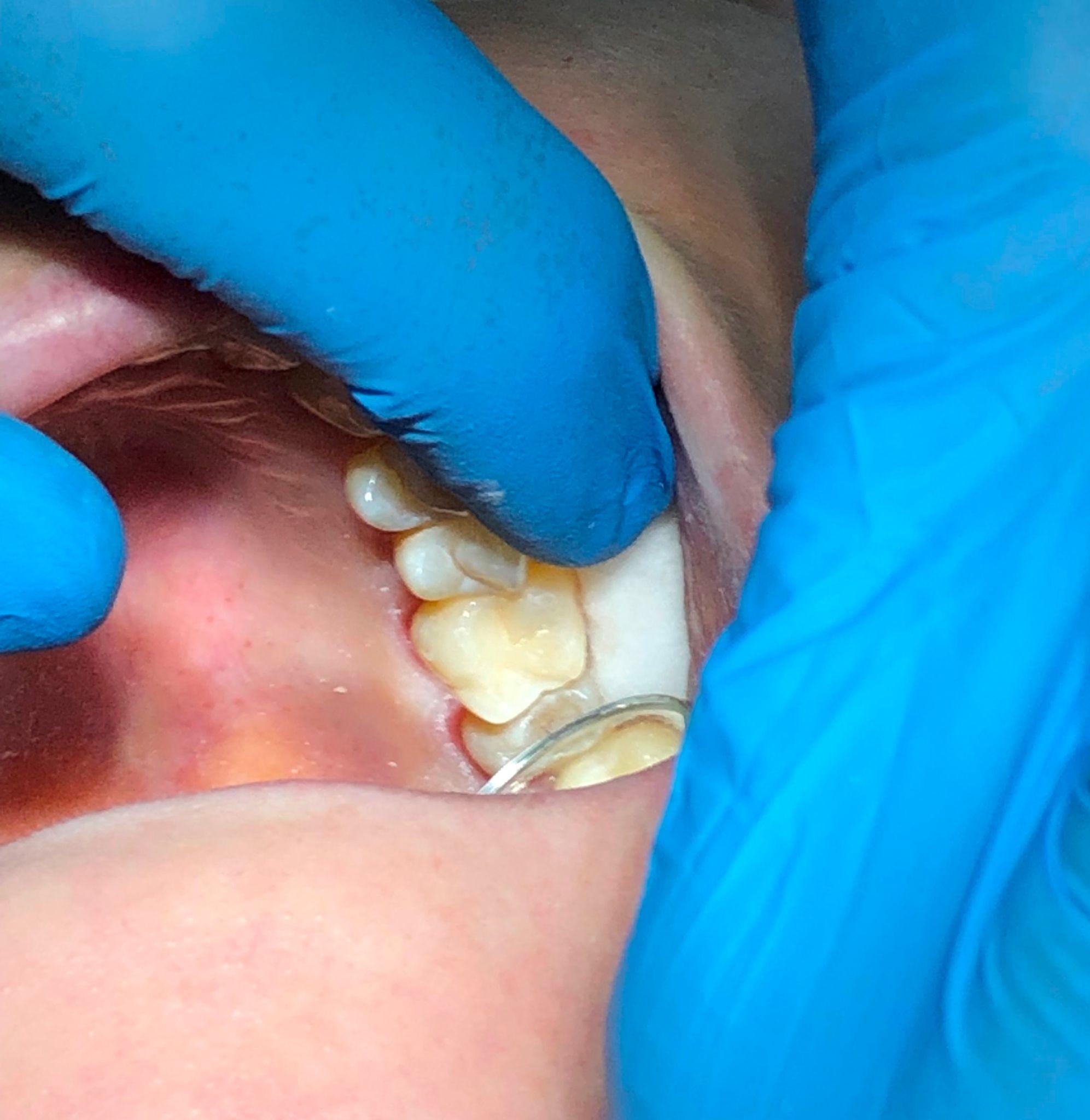 Dental Fillings in North Carolina