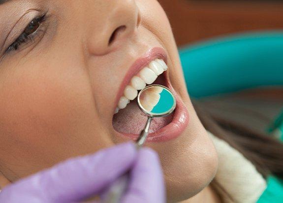 Dental Fillings in Raleigh NC