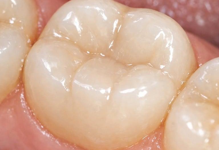 Dental Fillings in Raleigh