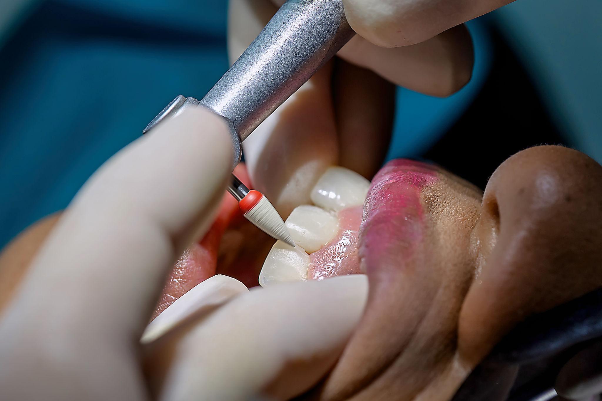 Dental Fillings in Siler City NC