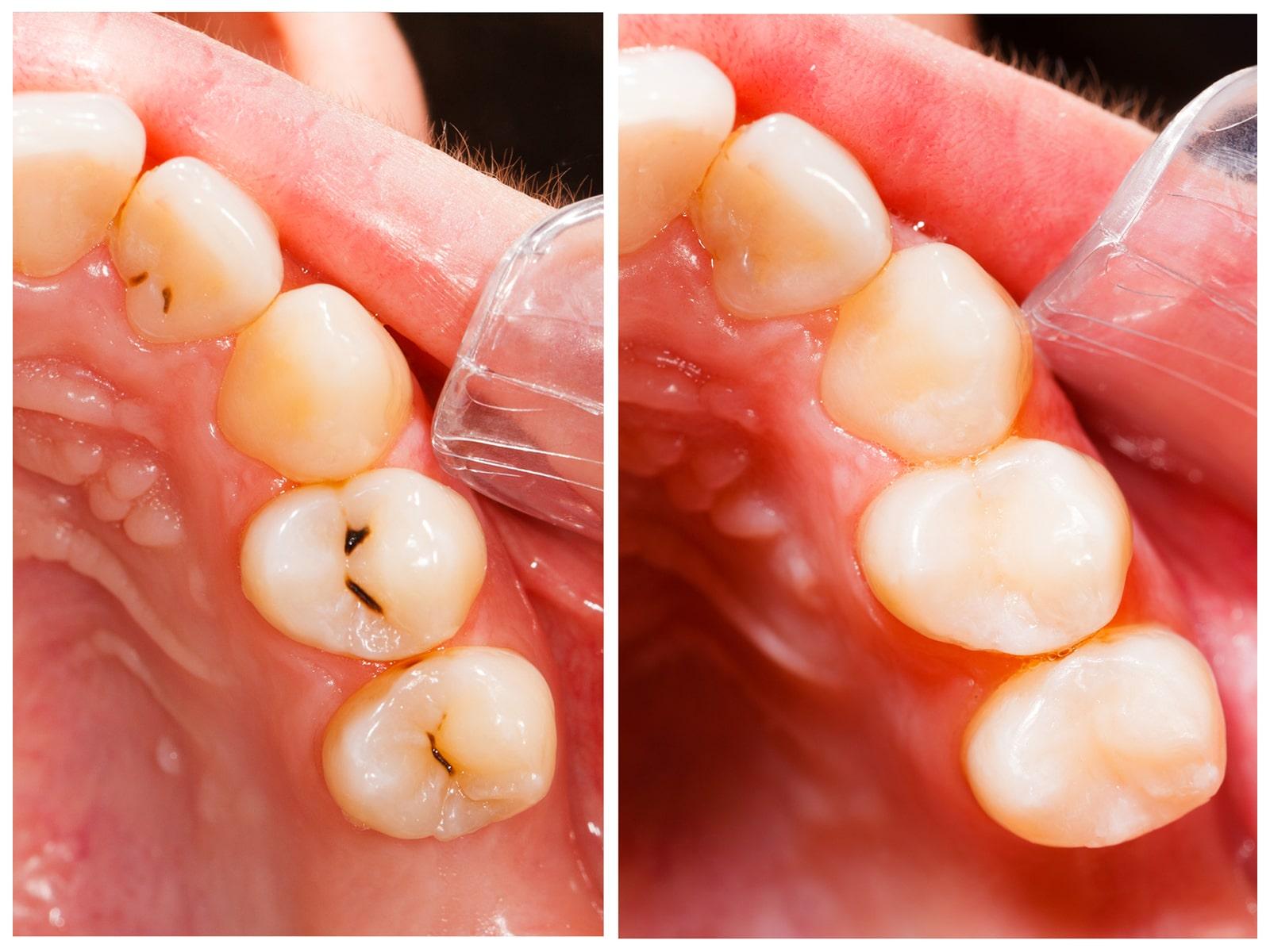 Dental Fillings in Southern Pines NC