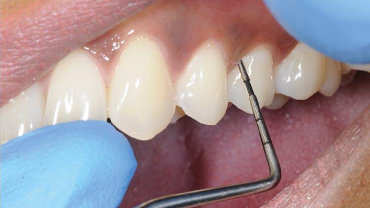 Gum Disease Treatment in Fayetteville NC 2