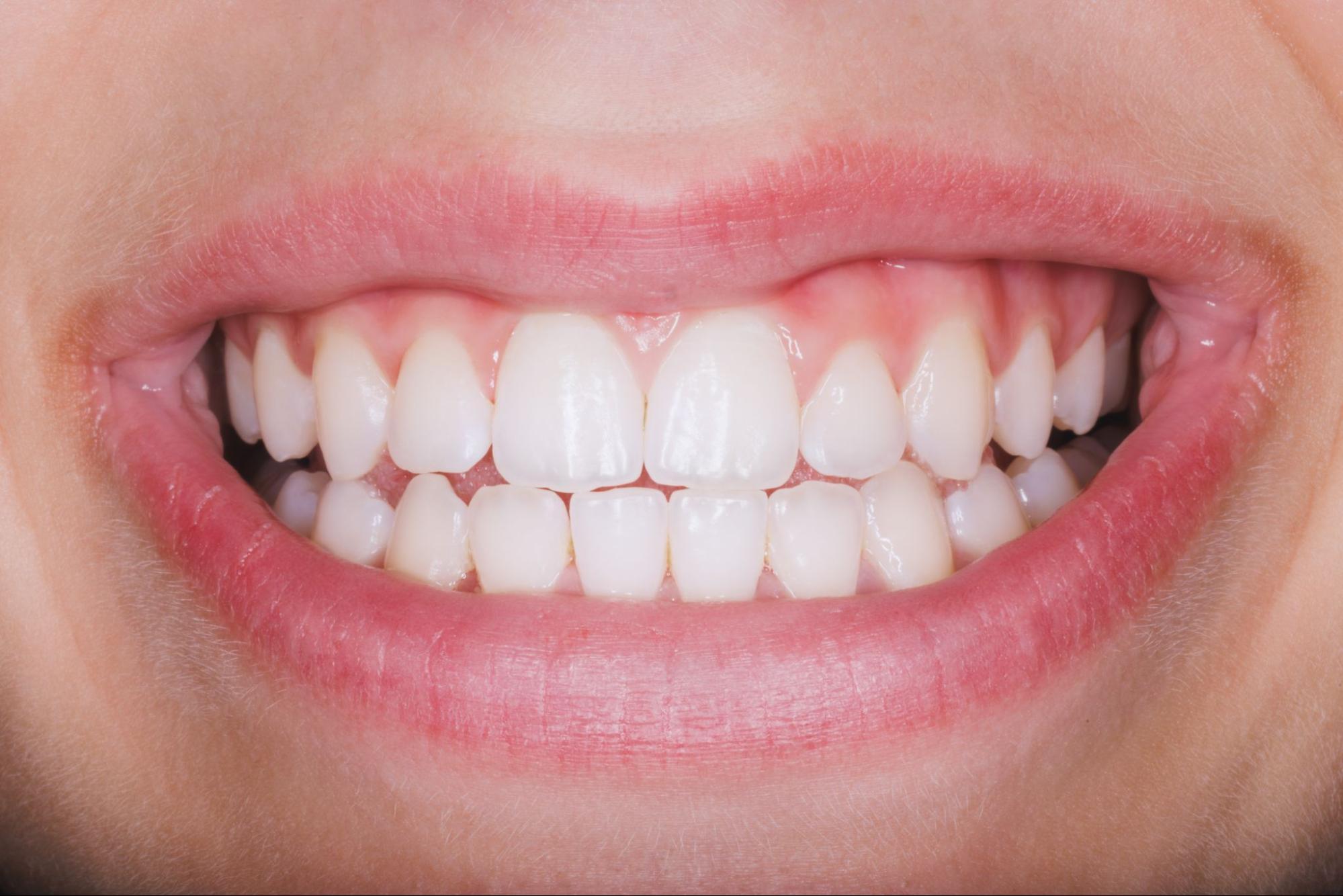 Gum Disease Treatment in Raleigh NC 2