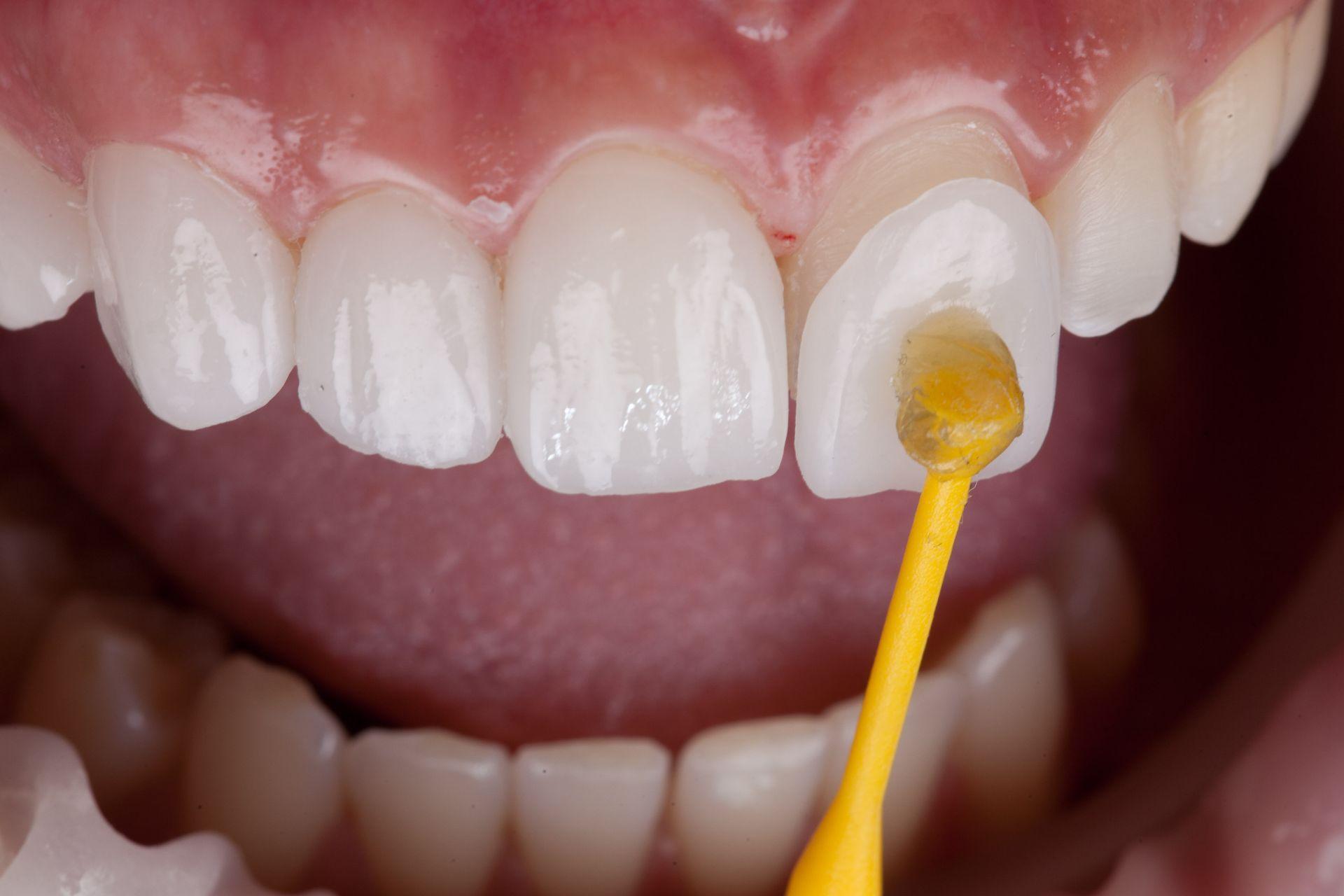 Porcelain Veneers Treatment in Siler City NC​