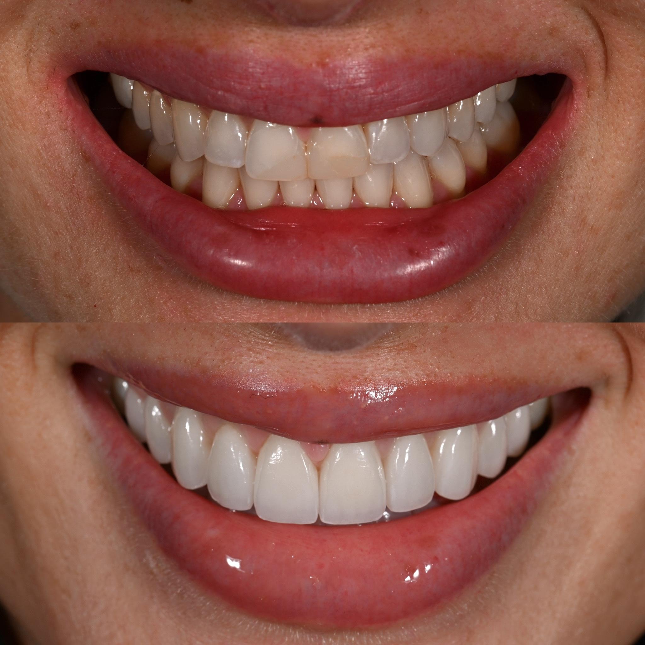 Porcelain Veneers Treatment in Fayetteville, NC​