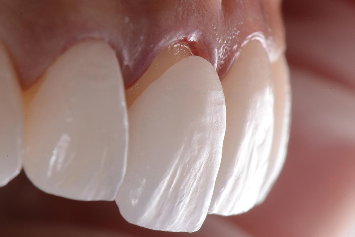 Porcelain Veneers in Siler City NC​